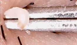 挤黑头视频,专业技巧与注意事项